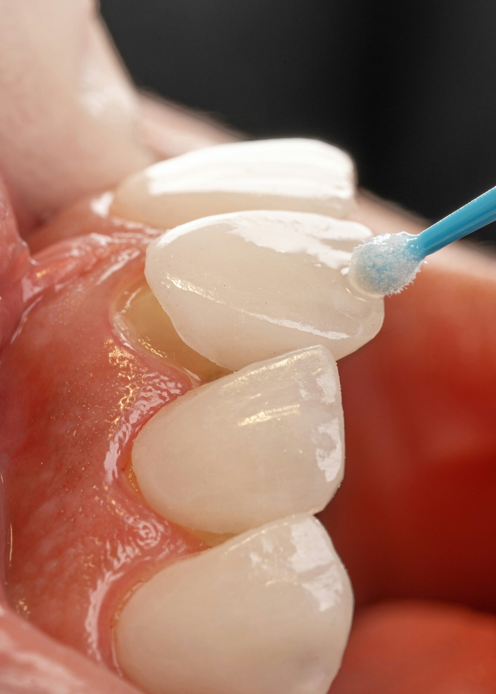 Composite Bonding in Turkey: Understanding Procedures, Prices, and Benefits